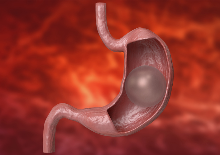 Balão intragástrico - Centro Saúde Brasil  
