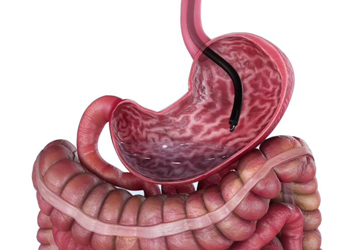 Gastroplastia - Centro Saúde Brasil 
